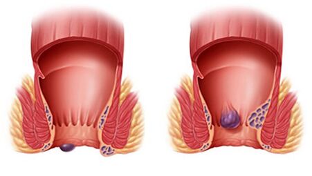 Proctonic aiuta con tutti i tipi di emorroidi